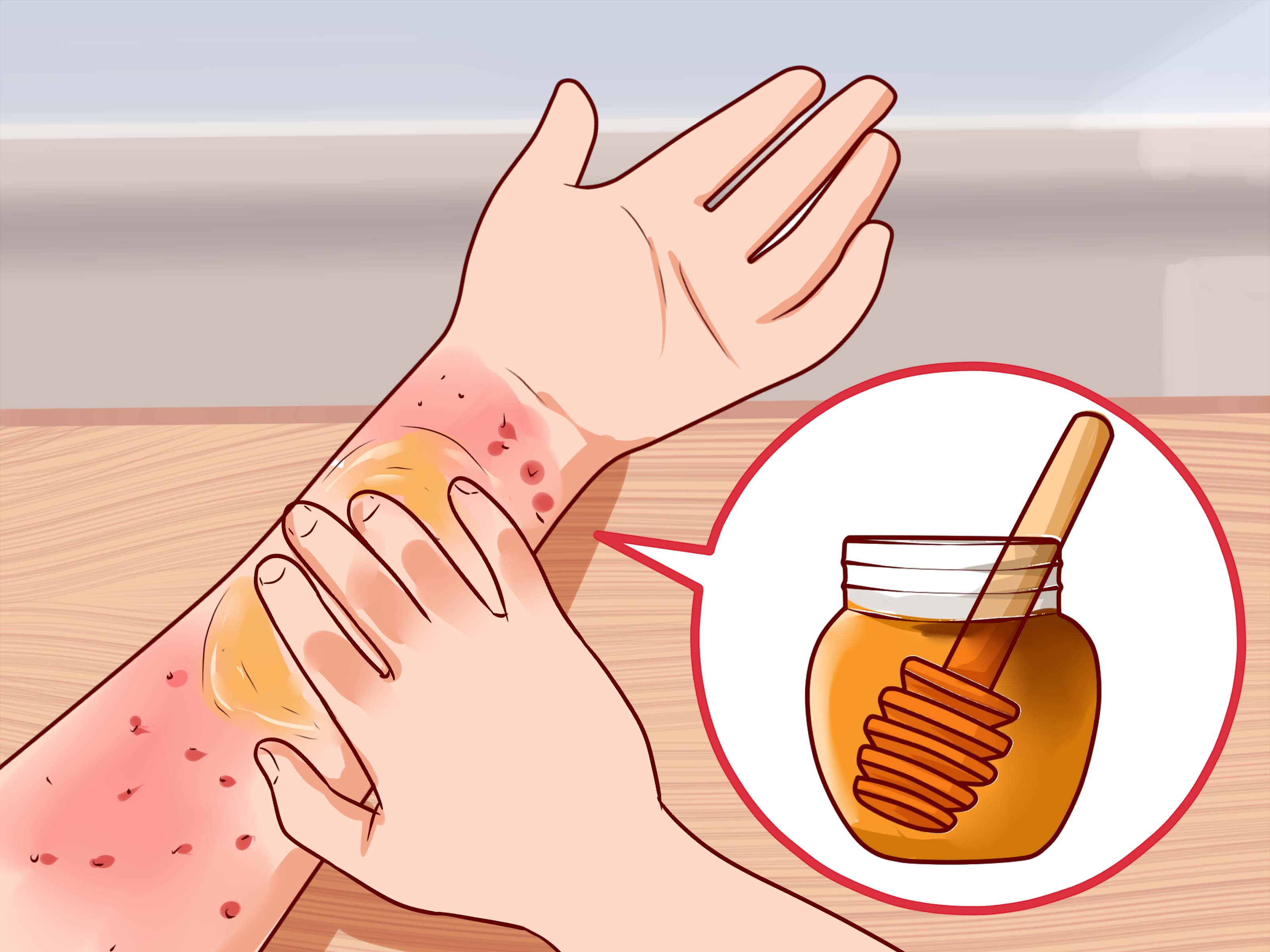 فوائد العسل للجروح