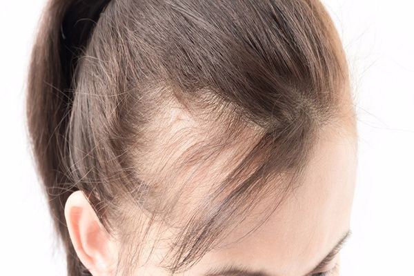 علاج تساقط الشعر الوراثي عند النساء