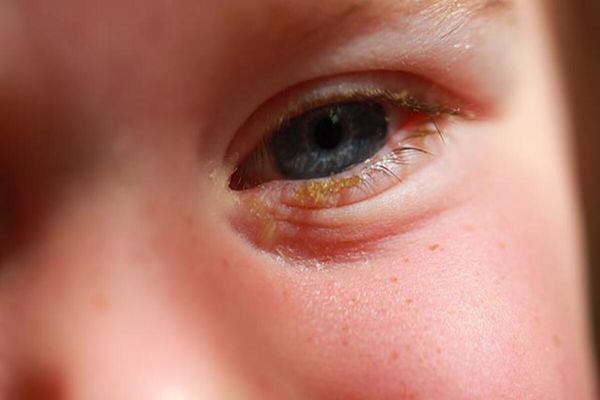 علاج التهاب العين بالشاي للاطفال