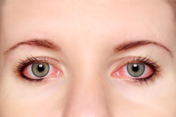علاج حساسية العين من الكحل