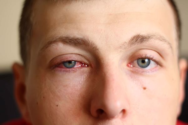 كيف تعالج التهاب العين الفيروسي