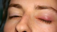علاج الكيس الدهني في العين بدون جراحة