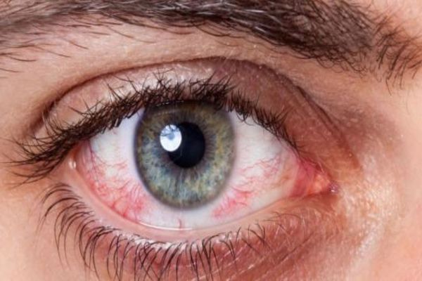 علاج تلف شبكية العين بالاعشاب