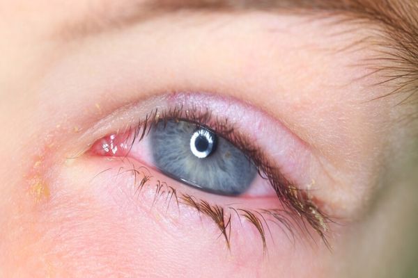 علاج التهاب العين الفيروسي في المنزل