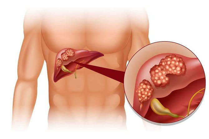 ما هي أعراض دهون الكبد