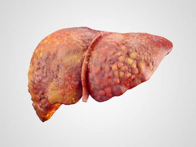 ما هو علاج ارتفاع انزيم الكبد