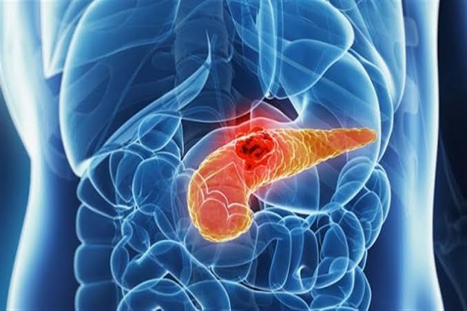 أعراض سرطان الكبد والبنكرياس