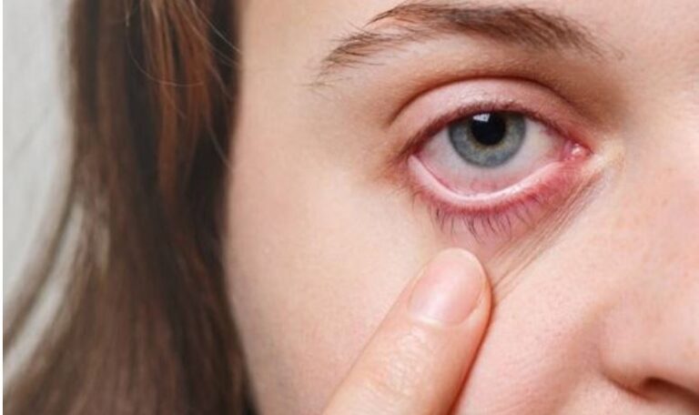 أضرار حساسية العين