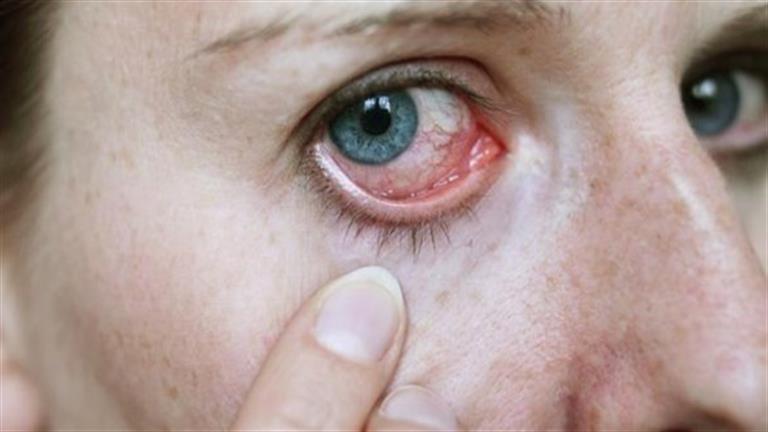 ما هو مرض الهربس في العين