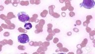 ما معنى ارتفاع Monocytes في تحليل الدم