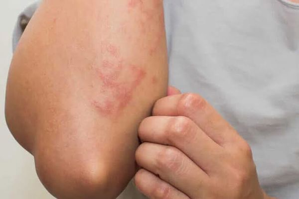 أسباب حساسية الجلد المفاجئة وعلاجها