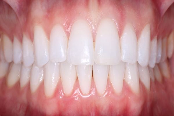 معلومات عن تركيبات الاسنان