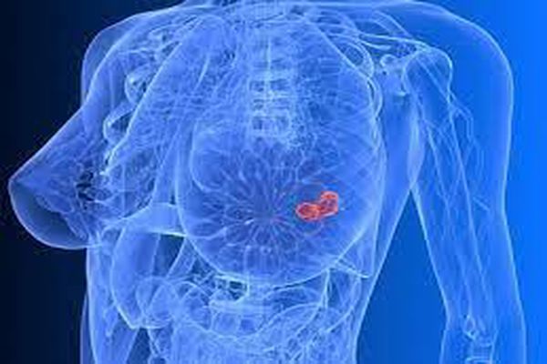 ما هي أعراض سرطان الثدي الحميد